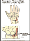 Thumbnail image of: Triangular Fibrocartilage Complex:  Illustration