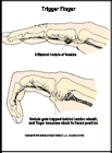 Thumbnail image of: Trigger Finger:  Illustration