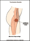 Thumbnail image of: Trochanteric Bursitis:  Illustration
