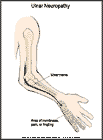 Thumbnail image of: Ulnar Neuropathy (Handlebar Palsy):  Illustration