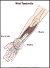 Thumbnail image of: Wrist Tendonitis:  Illustration