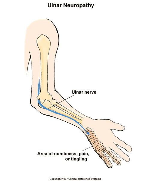 Ulnar Neuropathy (Handlebar Palsy):  Illustration