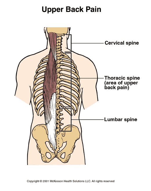 Upper Back Pain:  Illustration