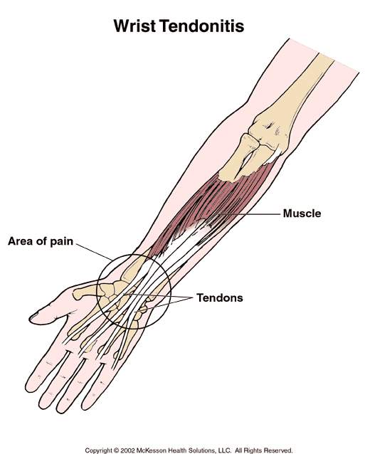 Wrist Tendonitis:  Illustration