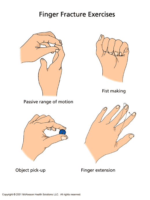 Finger Fracture Exercises:  Illustration
