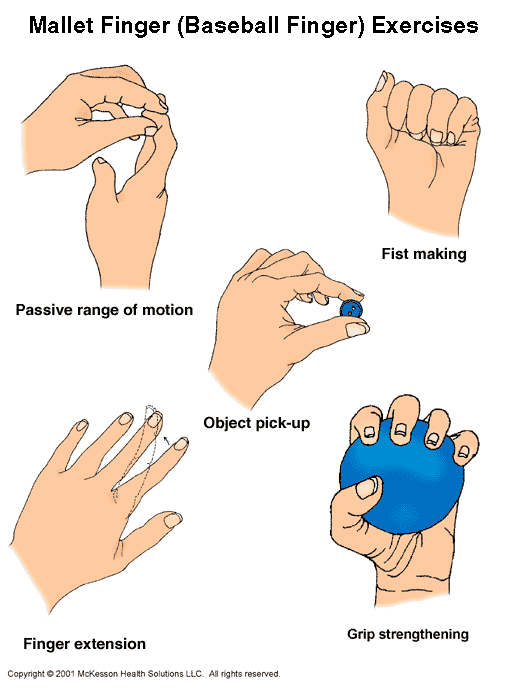Mallet Finger Exercises:  Illustration