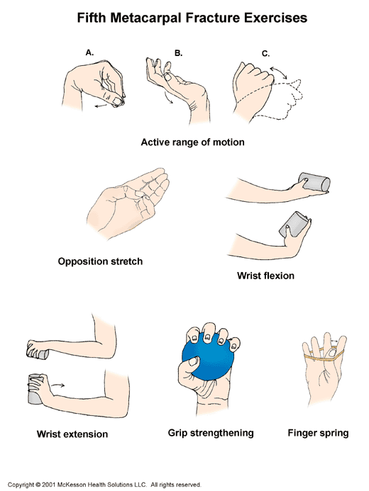 Fifth Metacarpal Fracture Exercises: Illustration