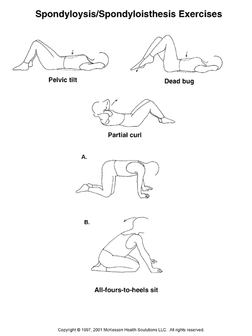 Spondylolysis and Spondylolisthesis Exercises:  Illustration