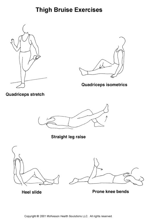 Quadriceps Contusion (Thigh Bruise) and Strain Exercises:  Illustration